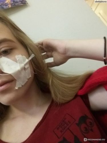 Гной после прокола гайморита