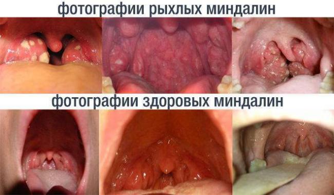 Тонзиллит после удаления миндалин