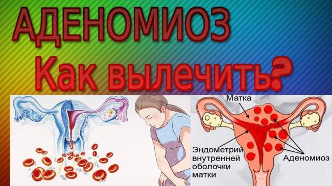 Симптомы аденомиоза