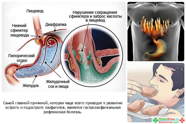 Гастроэзофагеальный рефлюкс — симптомы у детей и взрослых, лечение гастроэзофагеальной рефлюксной болезни
