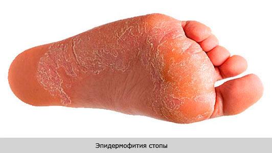 Паховая эпидермофития у женщин – лечение в домашних условиях