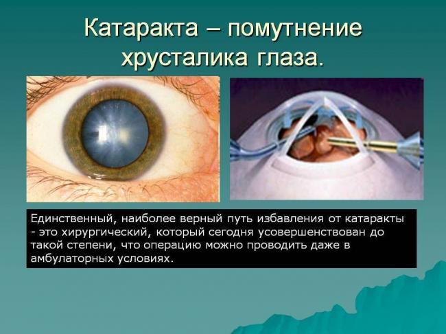 Как вести себя после операции по удалению катаракты глаза (замене хрусталика на иол)