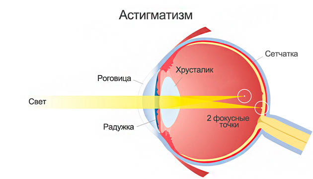 Отличия астигматизма от близорукости миопии