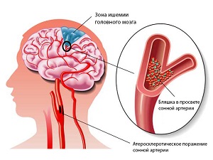 Энцефалопатия — виды, причины, лечение, симптомы, диагностика