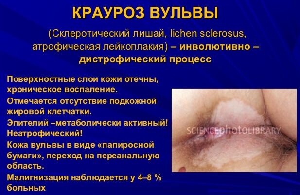 Лечение крауроза вульвы лазером
