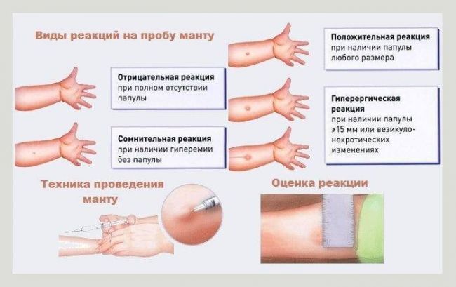 Доктор комаровский о пробе манту