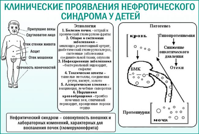 Нефротический синдром у детей: причины, симптомы, лечение и профилактика заболевания