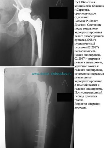Чем опасно эндопротезирование суставов
