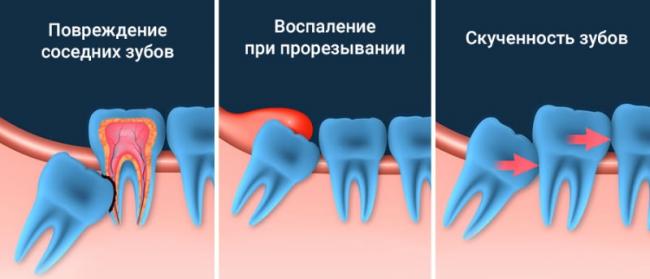 Удаление зуба мудрости заживление