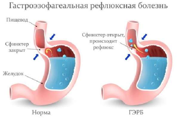 Как лечить остаточный кашель у взрослого