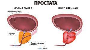 Финастерид отзывы