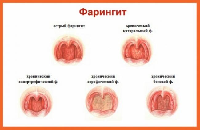 Обострение хронического тонзиллита