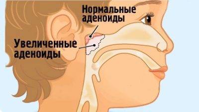 Как лечить кашель от аденоидов у ребенка?
