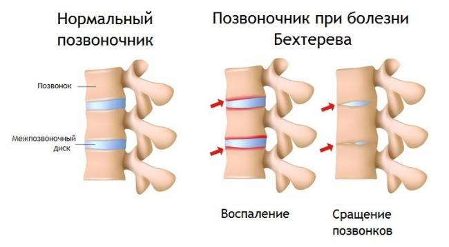 Болезнь бехтерева, или анкилозирующий спондилит – симптомы, причины развития и методы лечения.