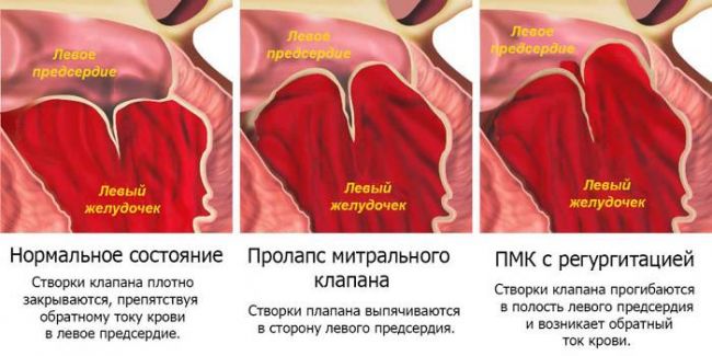 Пролапс гениталий