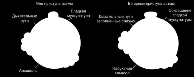 Сестринский уход при бронхиальной астме