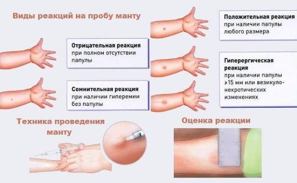 Можно ли делать манту ребенку, если у него кашель и насморк?