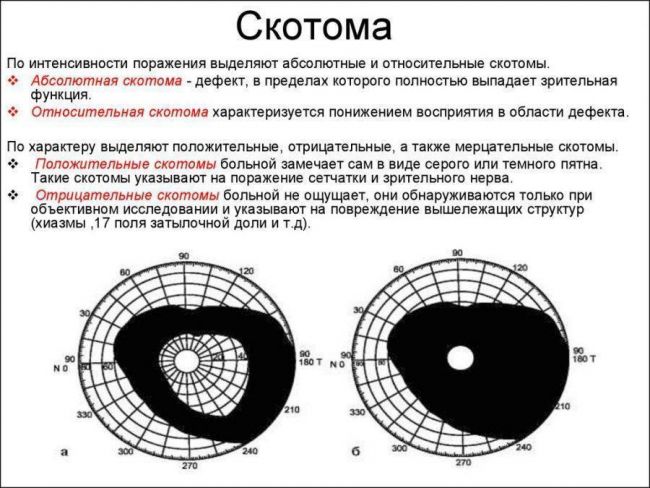 Скотома глаза: что это такое