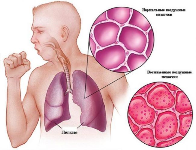 Кашель с болью в грудной клетке и отхаркивается