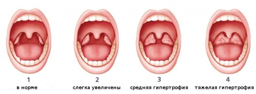 Лекарства от аденоидов