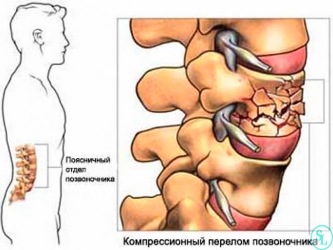 Компрессионный перелом позвоночника: причины, лечение, последствия