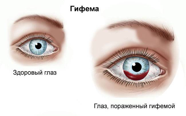 Как вылечить кровоизлияние в глазу народные средства