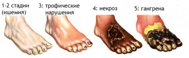 О симптомах и лечении болезни бюргера