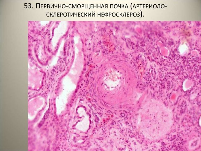Причины возникновения нефросклероза
