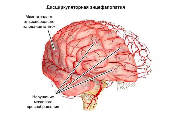 Дисциркуляторная энцефалопатия | симптомы | диагностика | лечение - docdoc.ru