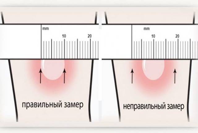 Что делать, если у ребенка положительная реакция манту