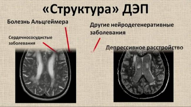 Энцефалопатия головного мозга – что это такое? причины, симптомы и лечение