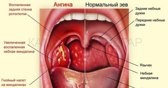 У ребенка болит горло – чем лечить, если постоянно больно глотать