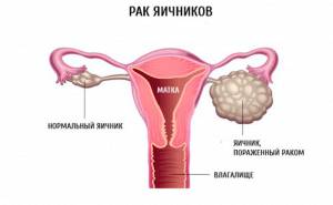 Сколько живут с диагнозом рак брюшной полости