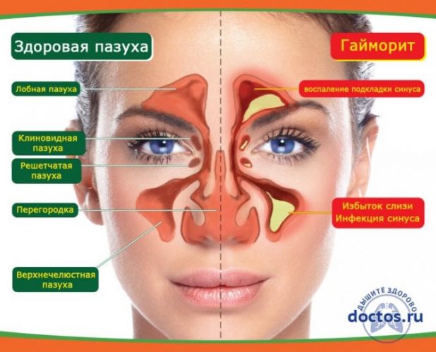 Двусторонний гайморит – лечение у взрослого: как лечить гнойный