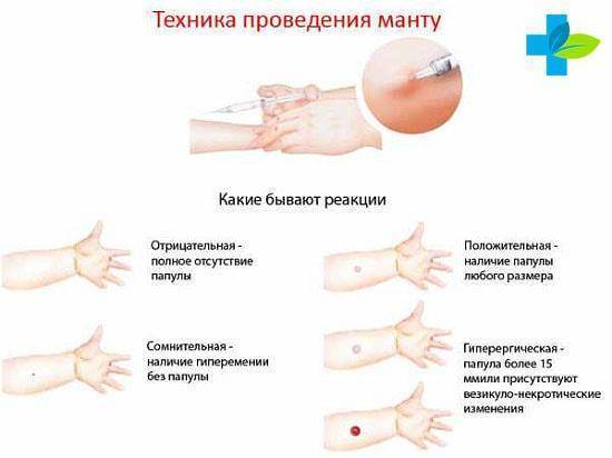 Манту отрицательная: что это значит и как выглядит такая реакция?