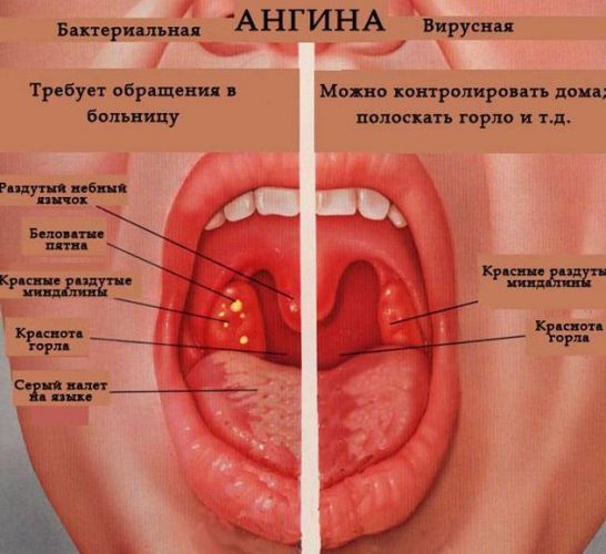 Лечение хронического тонзиллита у детей