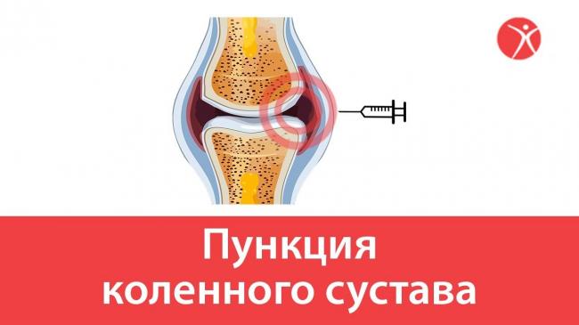Синовит сустава (коленный, тазобедренный, голеностопный, локтевой, лучезапястный и др.) - причины, симптомы, диагностика и лечение, народные средства