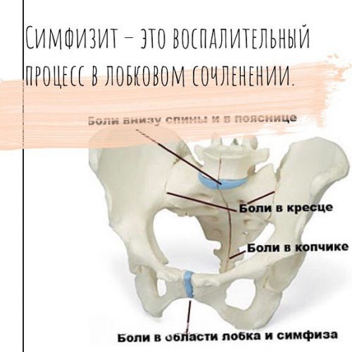 Лечение симфизита при беременности - диагностика, тактика родов, профилактика