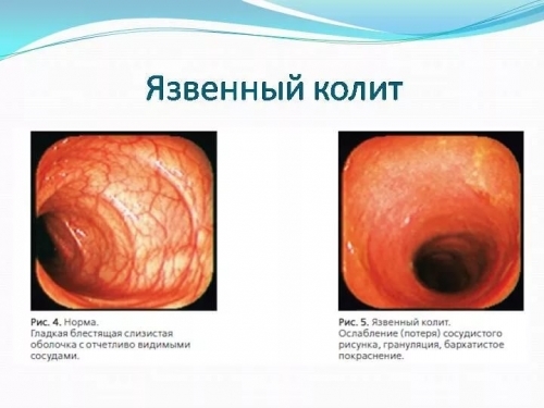 Гастрит кишечника