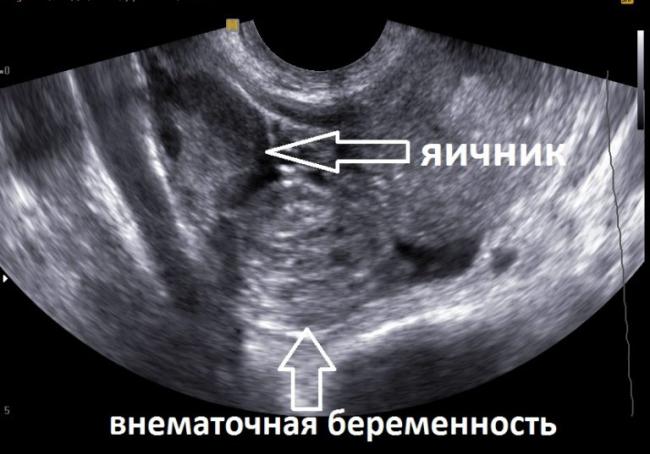 Внематочная беременность — признаки и лечение опасной патологии