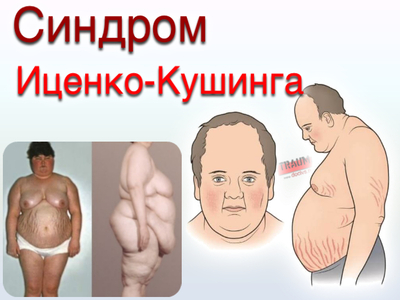 Синдром иценко-кушинга, болезнь иценко-кушинга, гиперкортицизм – что это такое? болезнь и синдром иценко-кушинга – причины, симптомы, лечение