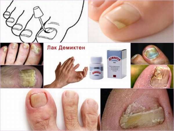 Лак от грибка ногтей демиктен
