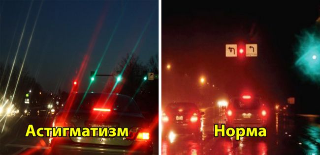 Виды и особенности лечения миопического астигматизма