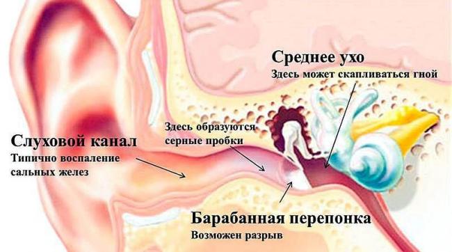 Лечение отита у детей антибиотиками – какие принимать