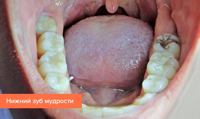 Рекомендации после удаления зуба мудрости – памятка для пациентов