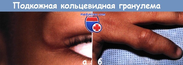 Кольцевидная гранулёма у ребёнка: лечить или забыть?
