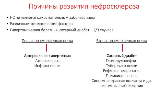 Нефросклероз (сморщенная почка) — что это такое, исход заболевания