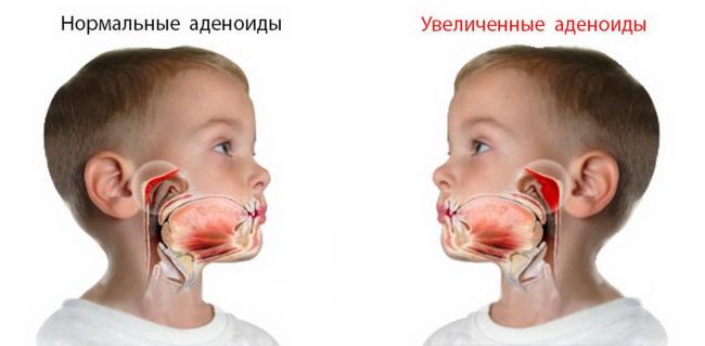 Аденоидит: причины, формы и степени, симптомы, тактика лечения