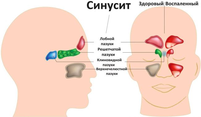 Воспаление слизистой носа: как лечить? причины. если болит