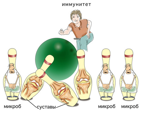 Артрит пальцев рук: симптомы и лечение